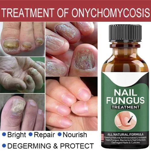 Fast Nail Fungal Treatment Serum